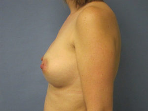 Breast Augmentation Before and After Pictures St. Louis, MO