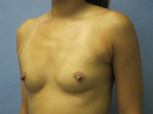 Breast Augmentation Before and After Pictures St. Louis, MO