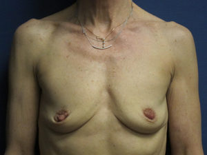 Breast Augmentation Before and After Pictures St. Louis, MO