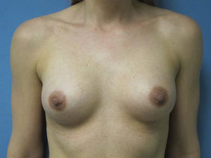 Breast Augmentation Before and After Pictures in St. Louis, MO