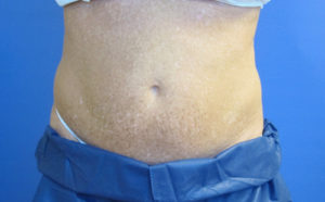 CoolSculpting® Before and After Pictures St. Louis, MO