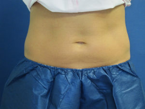 CoolSculpting® Before and After Pictures St. Louis, MO