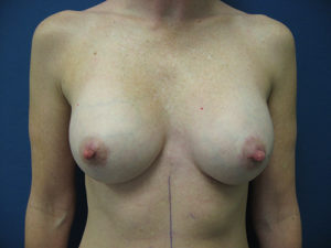 Breast Augmentation Before and After Pictures St. Louis, MO