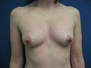 Breast Augmentation Before and After Pictures St. Louis, MO