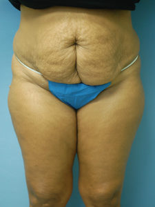 Tummy Tuck Before and After Pictures St. Louis, MO