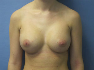 Breast Augmentation Before and After Pictures St. Louis, MO