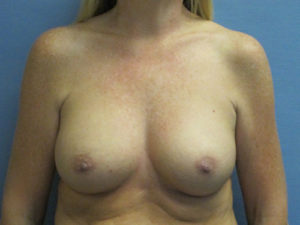 Breast Augmentation Before and After Pictures St. Louis, MO