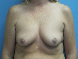 Breast Augmentation Before and After Pictures St. Louis, MO