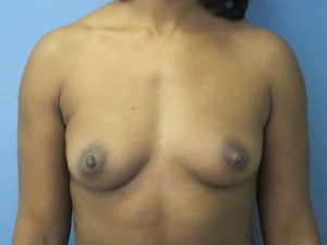 Breast Augmentation Before and After Pictures St. Louis, MO