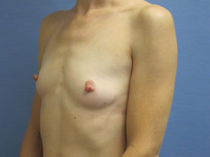 Breast Augmentation Before and After Pictures St. Louis, MO