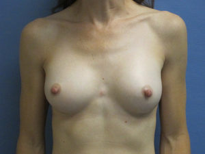 Breast Augmentation Before and After Pictures St. Louis, MO