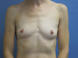 Breast Augmentation Before and After Pictures St. Louis, MO