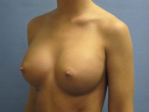 Breast Augmentation Before and After Pictures St. Louis, MO