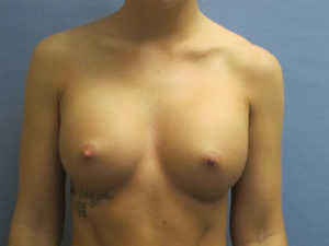 Breast Augmentation Before and After Pictures St. Louis, MO