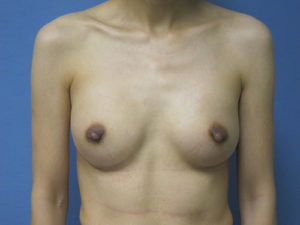 Breast Augmentation Before and After Pictures St. Louis, MO