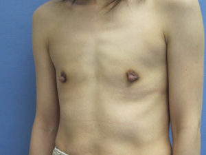 Breast Augmentation Before and After Pictures St. Louis, MO