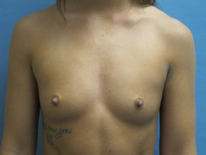 Breast Augmentation Before and After Pictures St. Louis, MO