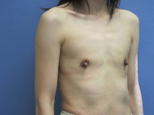 Breast Augmentation Before and After Pictures St. Louis, MO