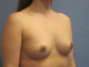 Breast Augmentation Before and After Pictures St. Louis, MO