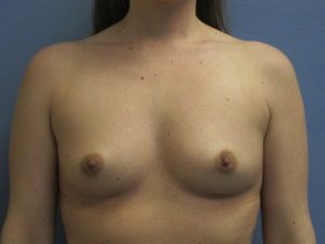 Breast Augmentation Before and After Pictures St. Louis, MO