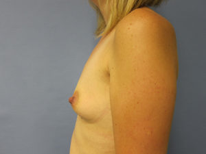 Breast Augmentation Before and After Pictures St. Louis, MO