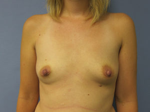 Breast Augmentation Before and After Pictures St. Louis, MO