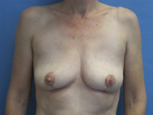 Implant Removal Before and After Pictures St. Louis, MO