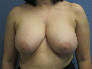 Implant Removal Before and After Pictures St. Louis, MO