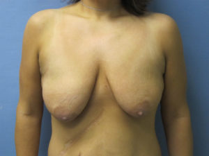 Breast Lift Before and After Pictures St. Louis, MO