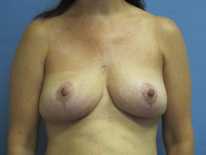 Breast Lift Before and After Pictures St. Louis, MO