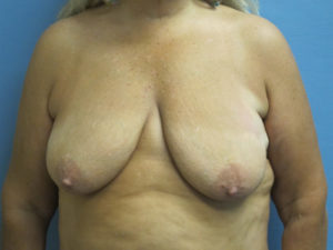 Breast Lift Before and After Pictures St. Louis, MO