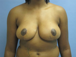 Breast Reconstruction Before and After Pictures St. Louis, MO