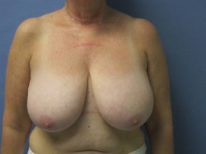 Breast Reduction Before and After Pictures St. Louis, MO