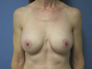 Breast Augmentation Before and After Pictures St. Louis, MO