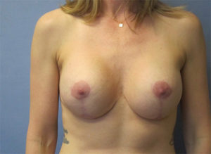 Breast Augmentation Before and After Pictures St. Louis, MO