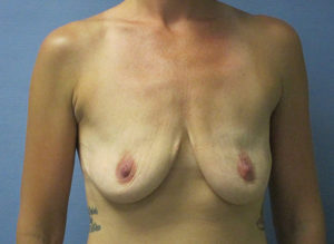 Breast Augmentation Before and After Pictures St. Louis, MO