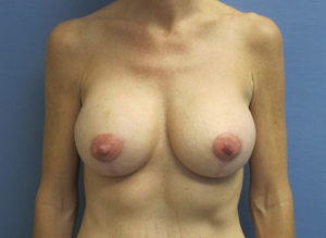 Breast Lift Before and After Pictures St. Louis, MO