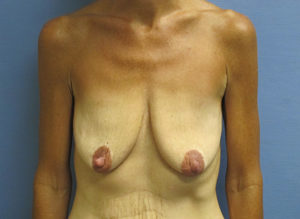 Breast Lift Before and After Pictures St. Louis, MO