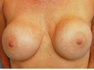 Breast Revision Before and After Pictures St. Louis, MO