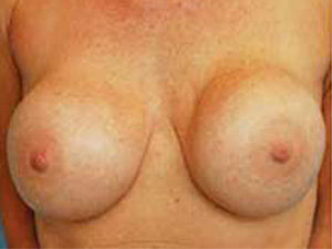 Breast Revision Before and After Pictures St. Louis, MO