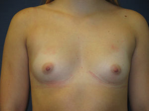 Breast Augmentation Before and After Pictures St. Louis, MO