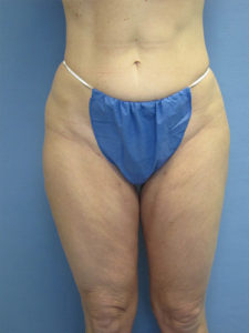 Liposuction Before and After Pictures St. Louis, MO