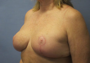 Breast Lift Before and After Pictures St. Louis, MO