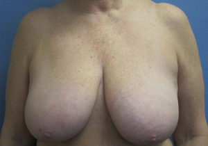 Breast Lift Before and After Pictures St. Louis, MO