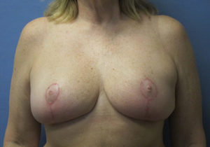 Breast Lift Before and After Pictures St. Louis, MO