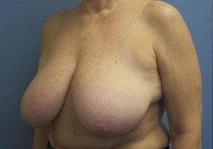 Breast Lift Before and After Pictures St. Louis, MO