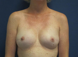 Breast Reconstruction Before and After Pictures St. Louis, MO