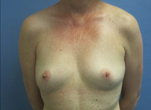 Breast Reconstruction Before and After Pictures St. Louis, MO