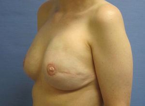 Breast Reconstruction Before and After Pictures St. Louis, MO