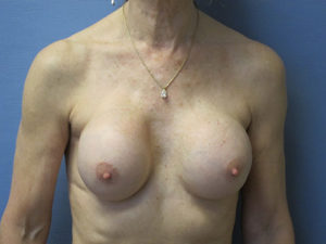Breast Revision Before and After Pictures St. Louis, MO